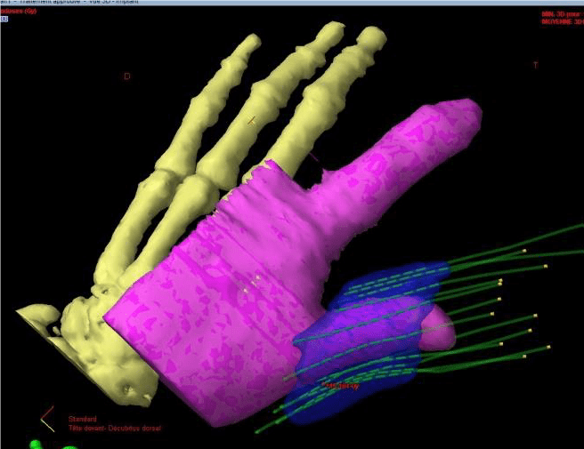 Exemple d’application à une tumeur localisée autour du pouce gauche