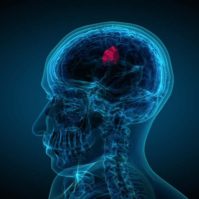 photo tumeur du cerveau