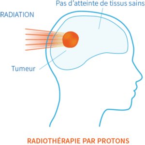 Schéma de radiothérapie par protons