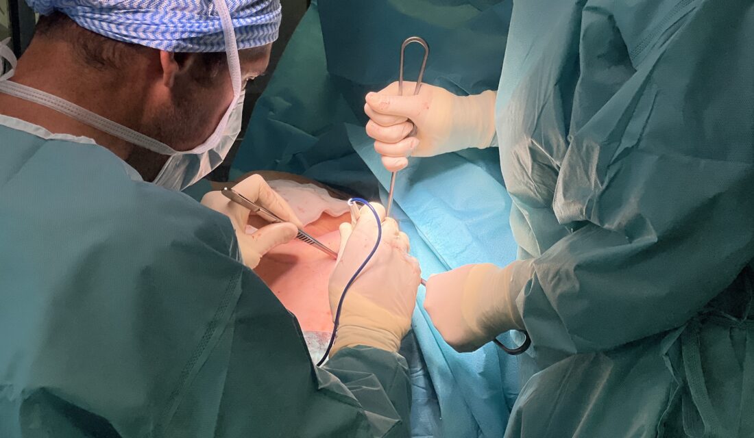 un chirurgien réalise une mastectomie par voie endoscopique